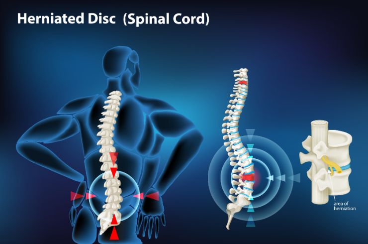 Spinal Infiltrations - Disc Herniation, Facet Arthropathy