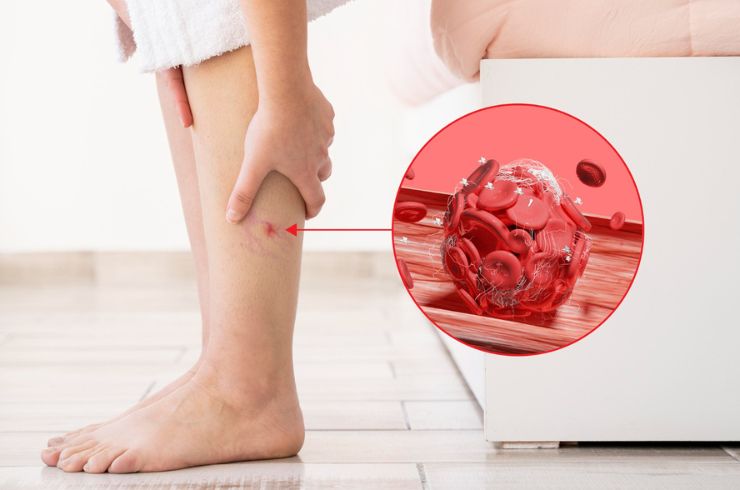 Thromboaspiration & Catheter-Directed Thrombolysis (CDT) for DVT & Pulmonary Thromboembolism